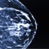 Breast Imaging and Digital Mammography 300x238 1