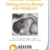 Adnexal Masses Distinguishing Benign and Malignant