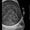 1637743367 1310793428 imaging mastery series high risk screening breast mri 2021
