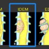 1638608714 1836170411 mri mastery series intradural extramedullary lesions idem 2020