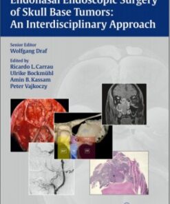 Endonasal Endoscopic Surgery of Skull Base Tumors: An Interdisciplinary Approach 1st Edition