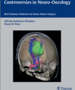 Controversies in Neuro-Oncology: Best Evidence Medicine for Brain Tumor Surgery 1st Edition