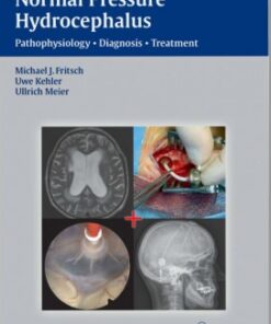 NPH - Normal Pressure Hydrocephalus: Pathophysiology - Diagnosis - Treatment 1st edition