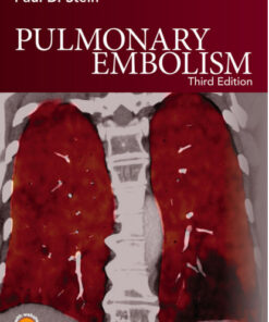 Pulmonary Embolism 3rd Edition