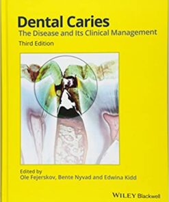 Dental Caries The Disease and Its Clinical Management PDF