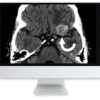 arrs clinical case based review of neuroradiology 2019 medical video courses 732700 720x