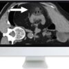 arrs cross sectional renal imaging techniques and diagnosis 2020 medical video courses 852471 720x