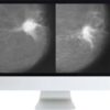 arrs harmonizing breast cancer screening recommendations hybrid course 2018 medical video courses 619322 720x 1