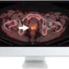 arrs molecular imaging and therapy of prostate cancer 2020 medical video courses 926931 720x