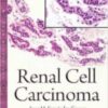 renal cell carcinoma 200x3001 1 176x264 1