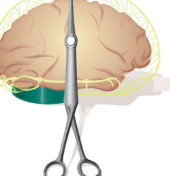 Brain surgery