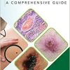 Skin Cancer: A Comprehensive Guide