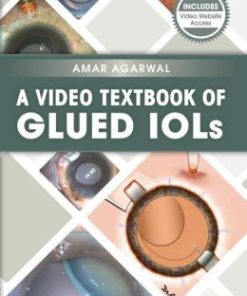 A Video Textbook of Glued IOLs