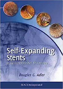 Self-Expanding Stents in Gastrointestinal Endoscopy