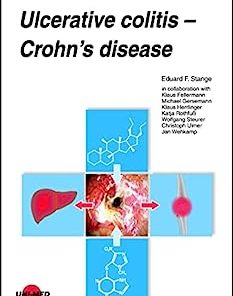 Ulcerative colitis – Crohn’s disease (UNI-MED Science)