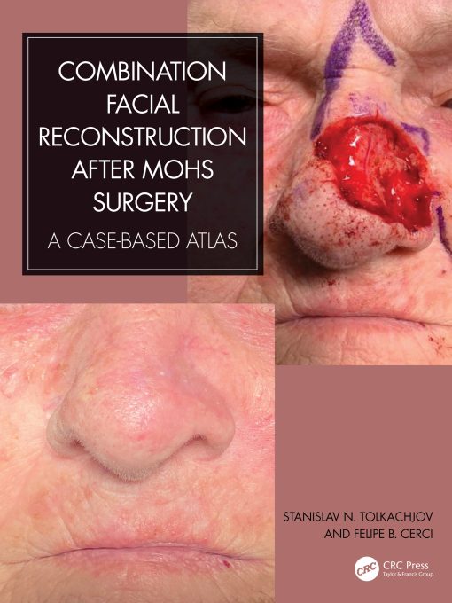 Combination Facial Reconstruction After Mohs Surgery (EPUB)