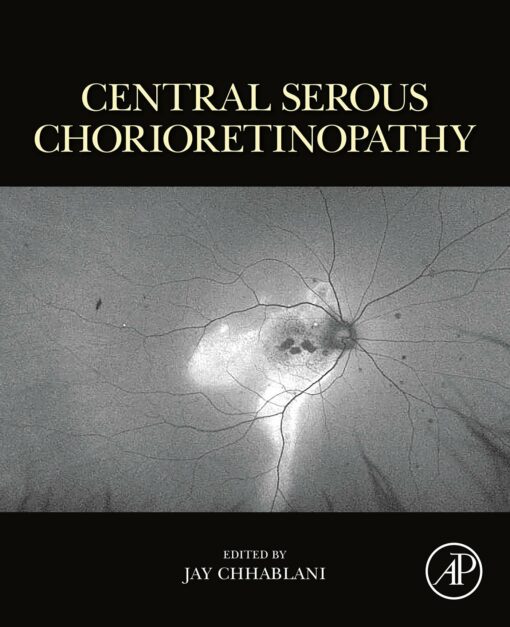 Central Serous Chorioretinopathy (EPUB)